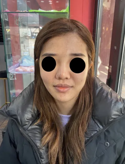 [안티에이징] ppkim0119 - 지방이식