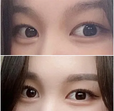 [눈] 연듀두 - 쌍꺼풀, 트임