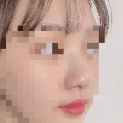 [코] 롱다랑사 - 코성형