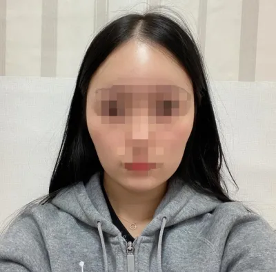 [안면윤곽] 레몬55 - 사각턱수술, 턱끝축소