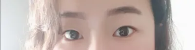 [눈] 라비라비옹 - 쌍꺼풀(절개)