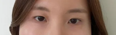 [눈] wyn - 앞트임, 눈매교정