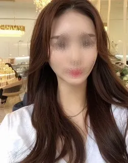 [안면윤곽] JOY - 윤곽