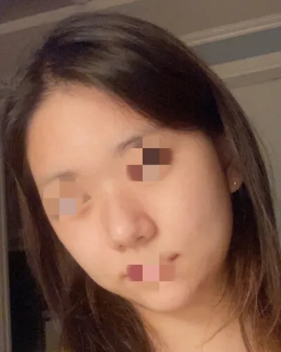 [안면윤곽] 아이셔 - 윤곽,코,얼지흡