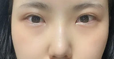 [눈] 뿔난 - 눈,코