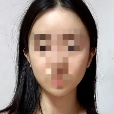 [안면윤곽] 민블리 - 안면윤곽