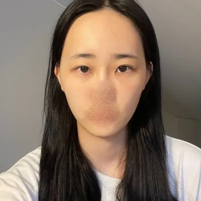 [눈] 삼삼오유 - 눈,지방이식,윤곽