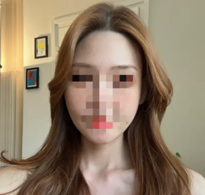 [안면윤곽] 라뷰v2 - 안면윤곽