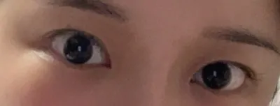 [눈] 수피앙 - 눈,지방이식