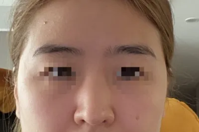 [코] 명지스 - 코,지방이식