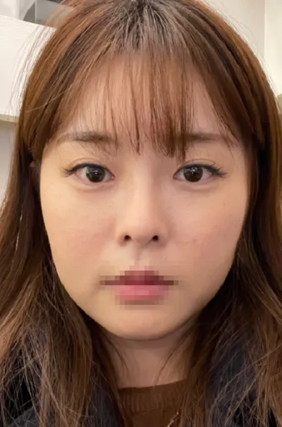 [안면윤곽] 합정카페 - 눈,코,얼굴지방흡입,윤곽