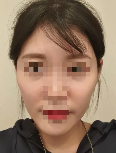 [안면윤곽] 촉촉한나라의쪼꼬칩쿠키 - 안면윤곽