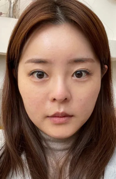 [눈] 토끼야 - 눈, 코, 윤곽, 얼굴지방흡입