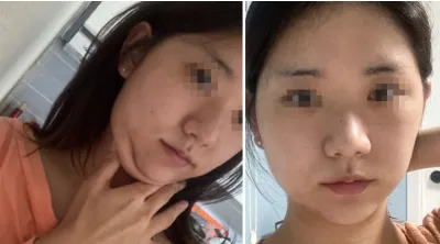 [안면윤곽] 각티슈 - 윤곽, 코