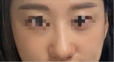 [코] 라이니 - 코