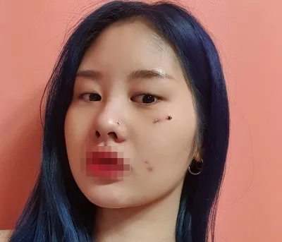 [눈] 의버지최고 - 눈,얼굴지방흡입