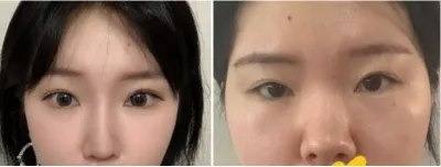 [눈] 뚱뚱코 - 눈,코