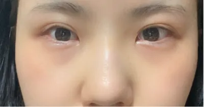 [눈] 뿌뿡이 - 눈,코