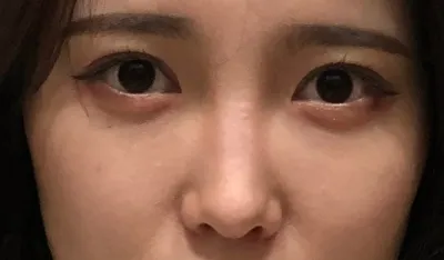 [코] 햇볕이 - 코