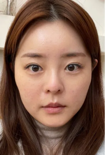 [코] 밍아밍어 - 눈, 코, 얼굴지방흡입