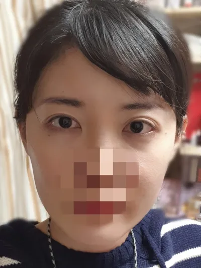 [안면윤곽] 여신대따 - 윤곽,눈