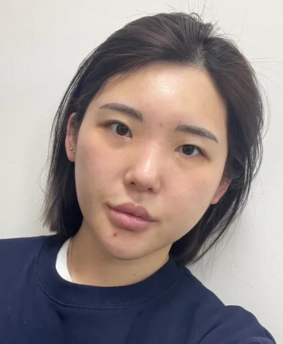 [눈] 복숭아 - 비절개 눈매교정(재수술), 윗트임, 밑트임