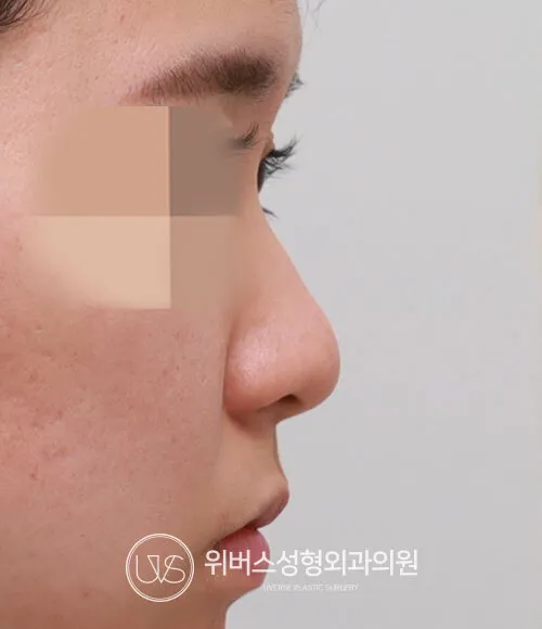 코끝+콧대(귀연골) Before