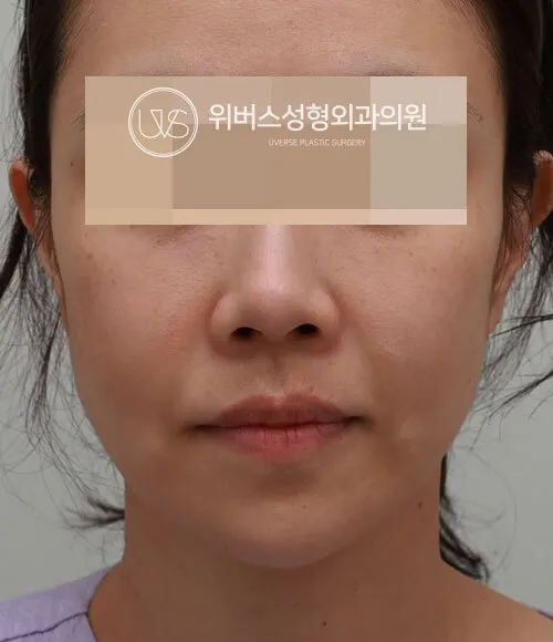 실리프팅 10줄 Before
