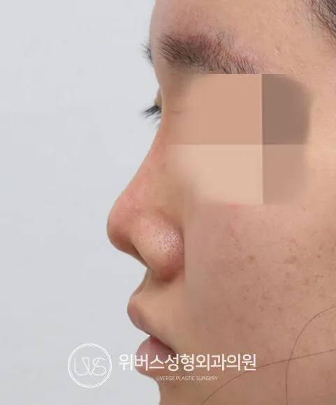 콧대 Before