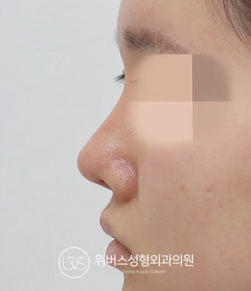 콧대 After