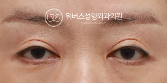 절개 Before