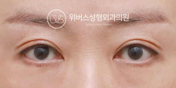 절개 After