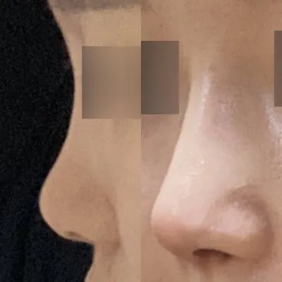 코 첫수술 위버스에서 받았어요