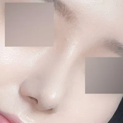 벌써 수술한 지 1달째입니당