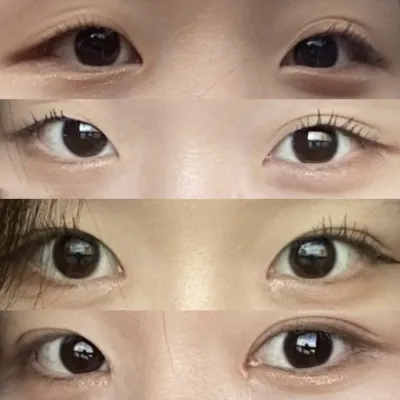 눈 수술 받았습니다 :)