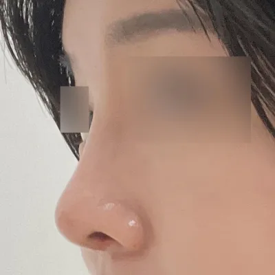 들창코 수술 했습니다~!