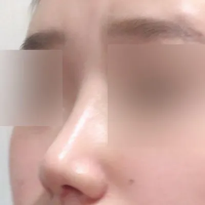 코 재수술 한 지 두달 됐어요