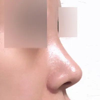 짧고 뭉툭한 코가 오똑해졌어요