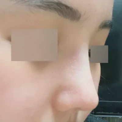 짧은코 + 기능코 수술 2달차에요