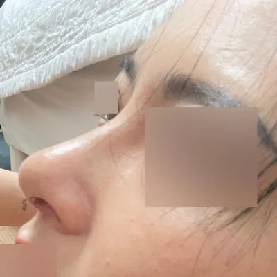 무보형물 코수술 받았어요^^