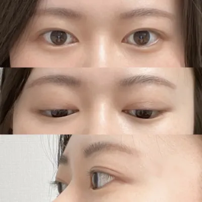 매몰, 눈매교정 후기