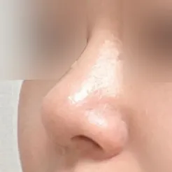 무보형물 복코 개선수술 후기