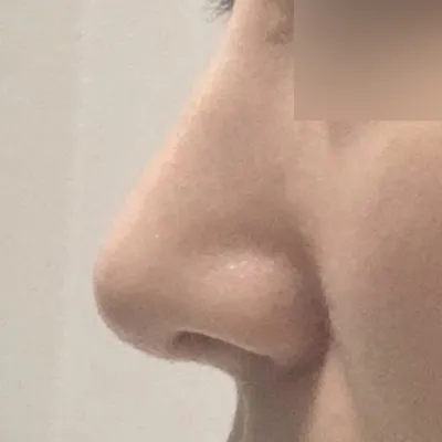 코수술한지 이제 거의 4개월차 됩니다