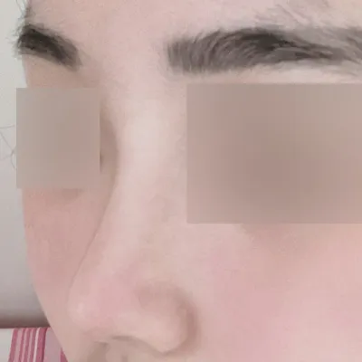 짧은코 + 기능코 수술 한 지 3달차에요!