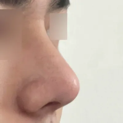 심정환 원장님께 수술 받은지 1달 됐습니다.