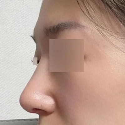 무보형물로 매부리코 수술 받았습니다!