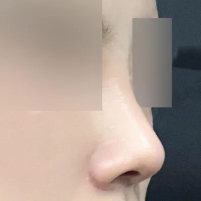 코 수술한지 한 달 됐어영!