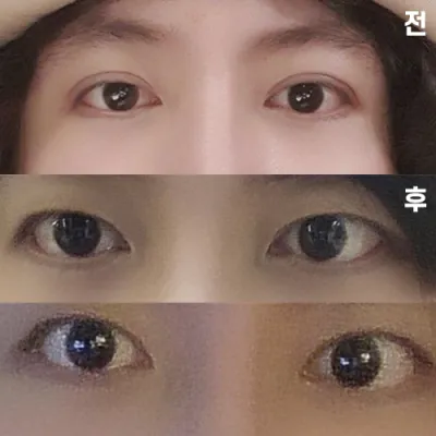 두줄따기 라인 낮추기 수술 후 경과 모습