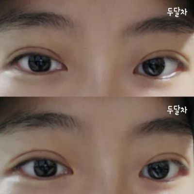 눈수술 두달차 찐후기입니다~^^