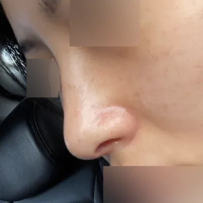 무보형물 코수술 받았어요